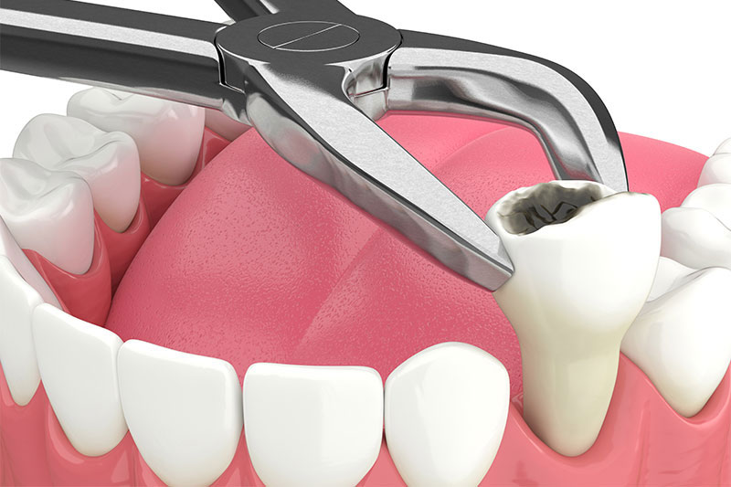 Tooth Extraction in Skokie