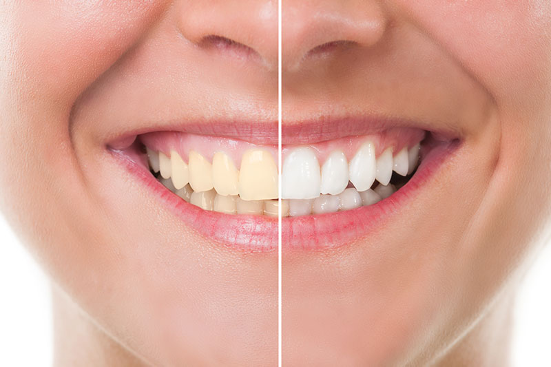 Teeth Whitening in Skokie