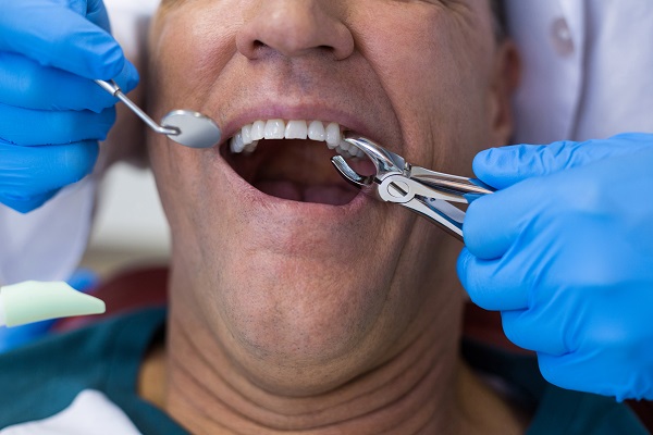 When And Why They Are Tooth Extractions Needed?